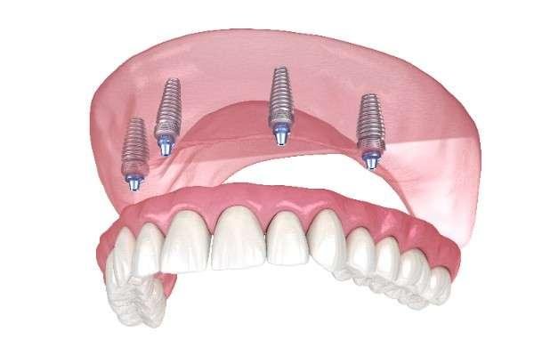dental implants Ayr